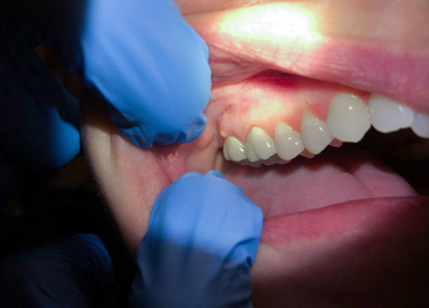 Best Emergency Dental Care for Abscessed Tooth in Shavano Park, TX
